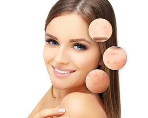 Post-Acne Marks ,Treating Acne Scars.Acne Scar Removal