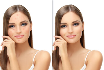 Post-Acne Marks ,Treating Acne Scars.Acne Scar Removal