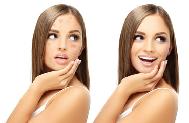Post-Acne Marks ,Treating Acne Scars.Acne Scar Removal