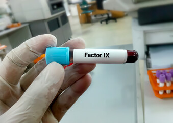 Blood Sample for Factor IX. Blood coagulation testing. Medical or health concept. Antihemophilic Factor B, Christmas disease, factor IX hemophilia
