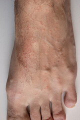 Fototapeta premium Allergic reaction on the leg. Rash on the foot. Dermatological disease. Pimples on the leg