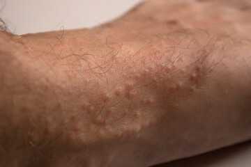 Allergic reaction on the leg. Rash on the foot. Dermatological disease. Pimples on the leg