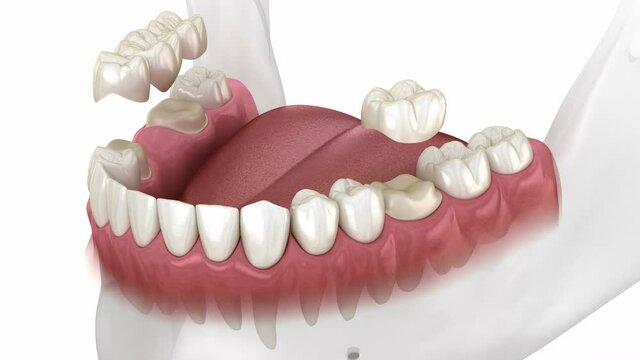 Instalation of dental bridge and single crown. Medically accurate 3D animation