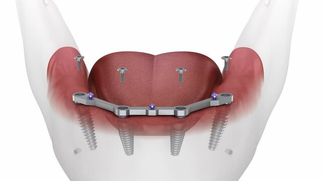 Mandibular prosthesis with gum All on 4 system supported by implants.  Medically accurate 3D animation