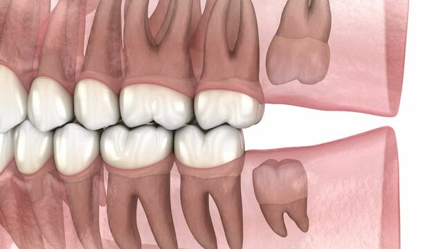 Wisdom tooth and gum inflammation. Medically accurate tooth 3D animation