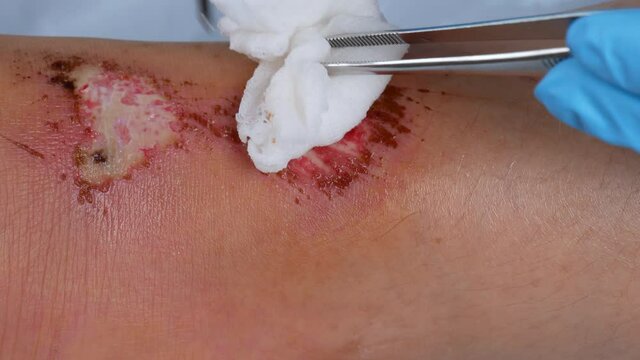 close up doctor cleaning wound on the leg, Injuries from falling