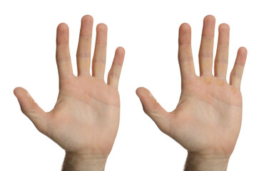 Man showing hands without and with calluses on white background., closeup. Collage