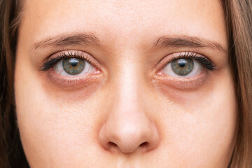 Cropped shot of a young woman's face. Green eyes with dark circles under eyes with red capillaries....