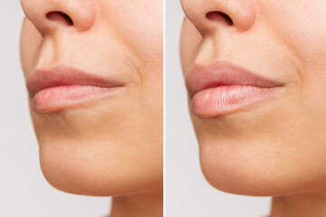 Cropped shot of young women's face with lips before and after lip enhancement on a gray background....