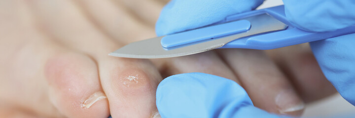Doctor surgeon in rubber glove removing dry callus on toe with scalpel closeup