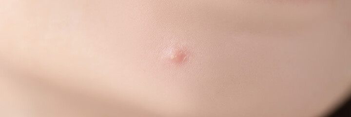 Fototapeta premium Closeup of white pimple on chin skin of young woman