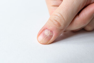 A nail with a crack on the finger of a man's hand on a light background.
