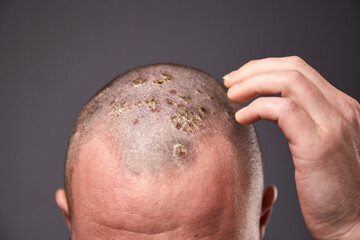 Man with dry flaky skin on his head with psoriasis and nail fungus on hands. Autoimmune genetic...