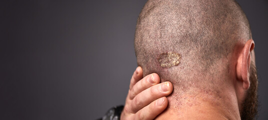 Man with dry flaky skin on his head with psoriasis and nail fungus on hands. Autoimmune genetic disease.