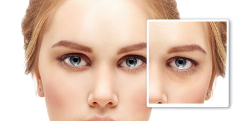 Lower and upper Blepharoplasty, plastic surgery concept.