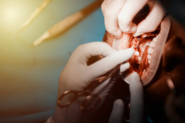 close-up of the process of implantation of teeth and tooth in a dental clinic operation
