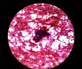 Hepatocellular Carcinoma Microscopic image of FNAC Fine Needle Aspiration Cytology test. Liver SOLs. Cancer