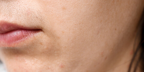 Girl's facial hair close-up. Banner with sore skin and hormone disorders in the female body.