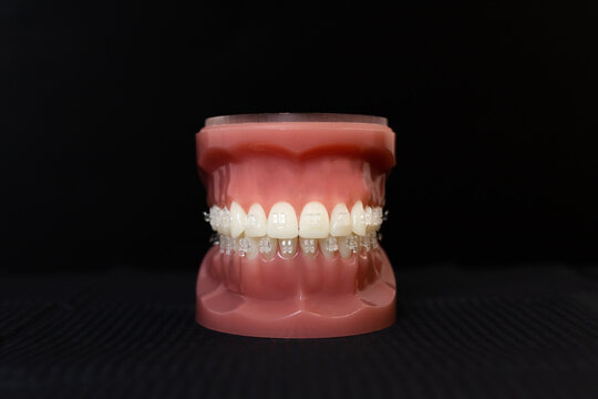 orthodontic jaw model, demonstration teeth with ceramic bracket or braces on black background