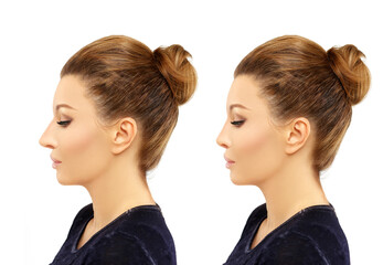 Rhinoplasty.Before and after