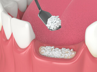 3D render of dental bone grafting with dental bone biomaterial - obrazy, fototapety, plakaty