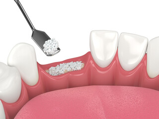 3D render of dental bone grafting with dental bone biomaterial - obrazy, fototapety, plakaty