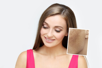 Fototapeta premium Dark spots, freckles,hyperpigmentation(melasma or chloasma),concept- skin lightening, skin whitening, Skin Brightening.