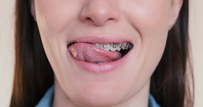 Happy woman licks teeth with braces, close-up. Cropped smiling female face mouth, dental braces system. Funny caucasian girl with metal teeth brackets. Orthodontic treatment. Oral health care. 4k