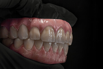 Dental Hybrid Prosthesis in Zirconia
