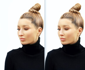 Rhinoplasty.Before and after. process of reconstructing nose