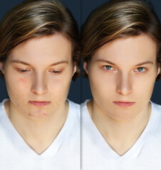 Post-Acne Marks .Treating Acne Scars.Acne Scar Removal