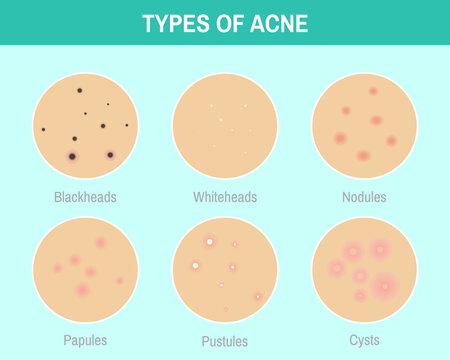 Types of acne. 6 circle images set of skin conditions. Colorful infographic for medical articles, posters and banners.