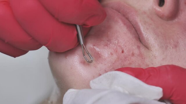 Squeezing acne from a girl with problem skin in the salon using a loop.