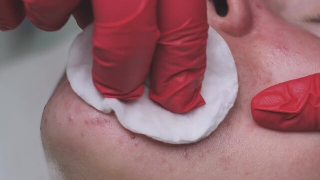 Wipe the mask off the face of a girl with problematic koja with cotton pads.