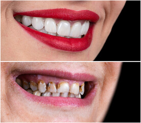 full mouth rehabilitation with press ceramic crowns and veneers