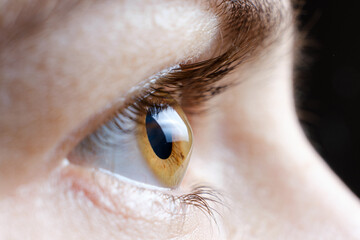 Macro photo of the human eye with corneal disease keratoconus - obrazy, fototapety, plakaty