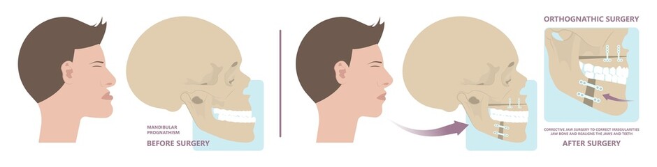 Jaw Surgery chin implant Sleep Apnea snoring upper airway plastic facial Cranio TMD TMJ joint Overbite teeth dental birth defects Open bite pain trauma cosmetic gummy smile bone reconstructive bad © Pepermpron