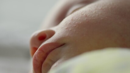 Macro shot of a sleeping childs face affected by diathesis. Troubled face skin of a small caucasian baby.   Cinematic footage of childs face with skin defect. Closeup footage of babies cheecks.