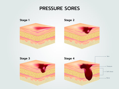 bedsore Stages of Pressure Sores