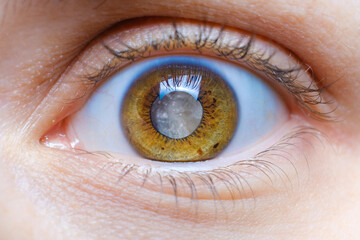 Human eye with clouded lens, white pupil, cataract macro - obrazy, fototapety, plakaty