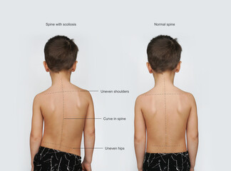 Signs Of Scoliosis. Normal healthy spine and curved spine with scoliosis.Scoliosis in children - obrazy, fototapety, plakaty