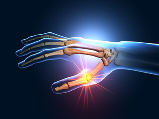 Painful hand joints, medical 3D illustration