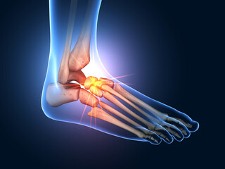 Painful foot joints, medical 3D illustration - obrazy, fototapety, plakaty
