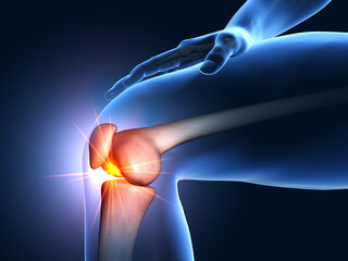 Painful knee joint, medical 3D illustration - obrazy, fototapety, plakaty