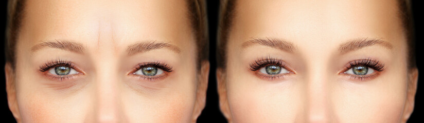 Fototapeta premium Lower and upper Blepharoplasty..Before and after cosmetic procedures,showing photos