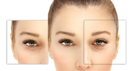Lower and upper Blepharoplasty..Before and after cosmetic procedures,showing photos