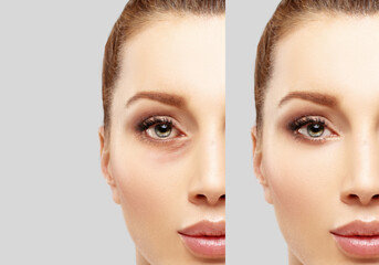 Lower  Blepharoplasty. plastic surgery concept.