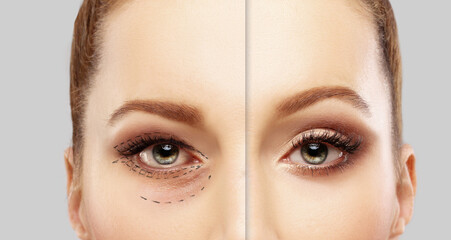Lower and upper Blepharoplasty.Marking the face.Perforation lines on females face, plastic surgery...