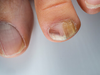 Nail infections caused by fungi such as: onychomycosis also known as tinea unguium. Caused by dermatophytes and yeasts and for the concomitant antibacterial activity