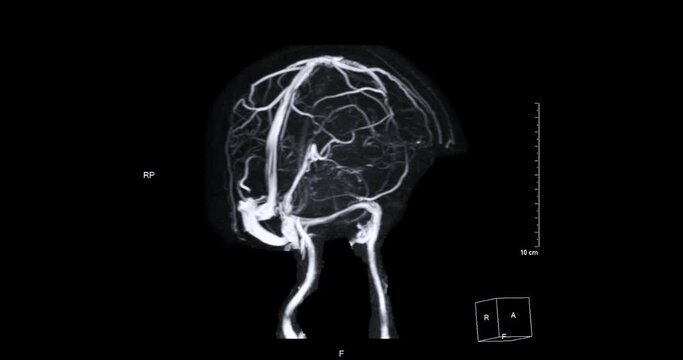 MRV Brain or magnetic resonance venography of The Brain turn around on the screen for abnormalities in venous drainage of the brain.